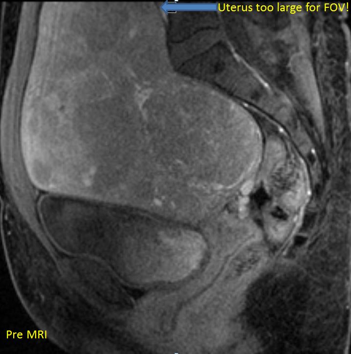 ABrandisMD's tweet image. Just saw a TRUFE patient in follow-up.  All smiles!  Sx resolved.  MRI was impressive #RadialFirst #Shrinkage
