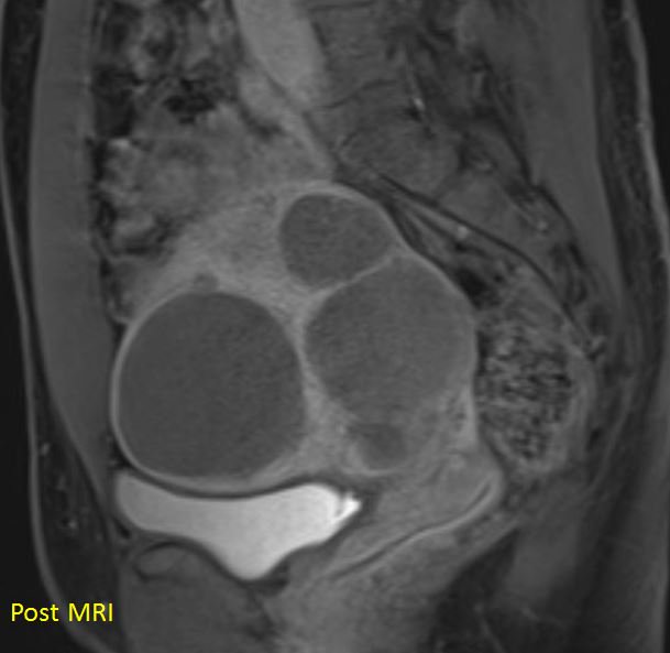 ABrandisMD's tweet image. Just saw a TRUFE patient in follow-up.  All smiles!  Sx resolved.  MRI was impressive #RadialFirst #Shrinkage