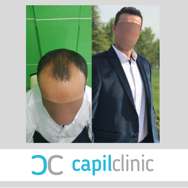capilCLINIC's tweet photo. 1 año  después del injerto capilar en Turquía con #capilClinic #DrEtoz #Acibadem #trasplanteCapilarTurquía #injertoCapilarTurquía https://t.co/qVwOEhy8RM