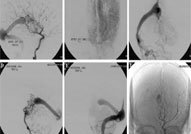 AustinGroups1's tweet image. austinpublishinggroup.com/cerebrovascula…
#Massive #Intracranial #Calcifications #Secondary #to #Vein #of #Galen #Aneurysmal #Malformation
