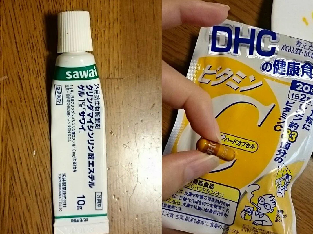 ニキビで悩む人に朗報！サワイ製薬の塗り薬とDHCのサプリで1か月でここまで綺麗に！