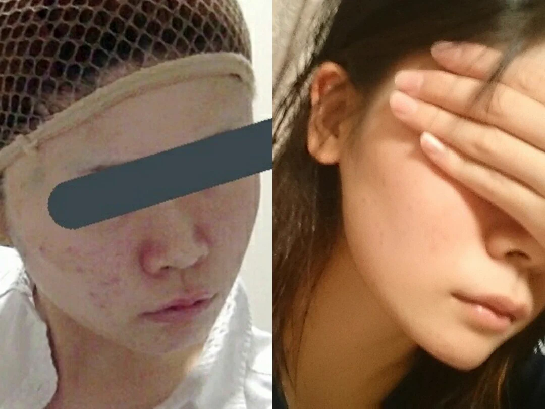 ニキビで悩む人に朗報！サワイ製薬の塗り薬とDHCのサプリで1か月でここまで綺麗に！