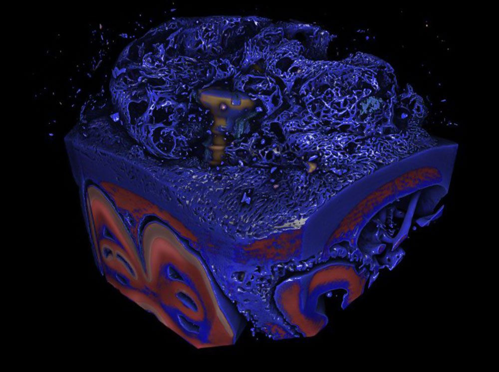 Adalidda's tweet photo. #QUT Research is behind the First #3Dprinted #ShinBone Implant #AdditiveBiomanufacturing #ABM https://t.co/lcycDIm6vO https://t.co/eD7bsurWHW