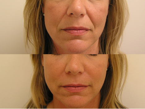 privateclinic's tweet photo. A little well-placed filler helps you look your best. We can hold back the lines but not the compliments! #TPCTLC #filler #antiageing https://t.co/mthVBah2TA