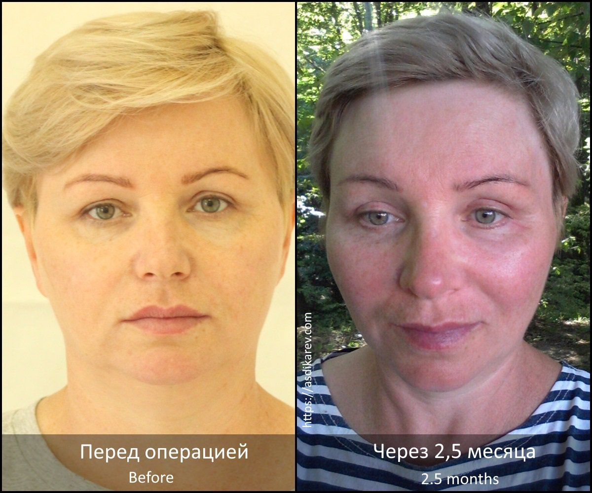 Эндоскопическое омоложение лица