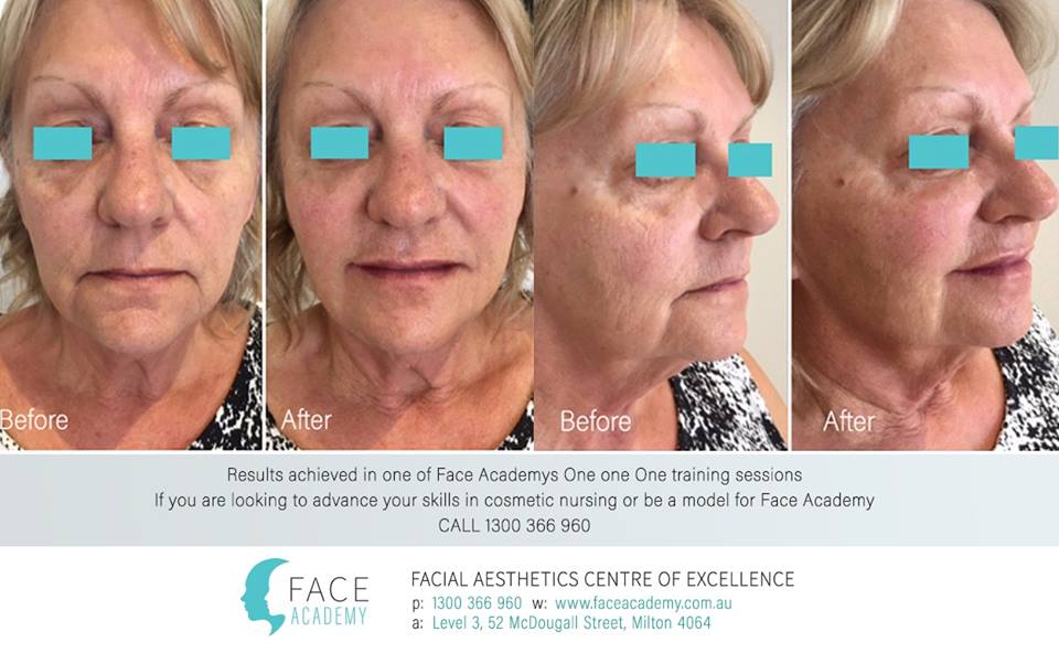 FaceAcademyAUS's tweet photo. Recent results in one of our one-on-one #facialaesthetics #trainingsessions at face academy! Learn new skills for a #cosmeticnurse! https://t.co/fjucNCc8i1
