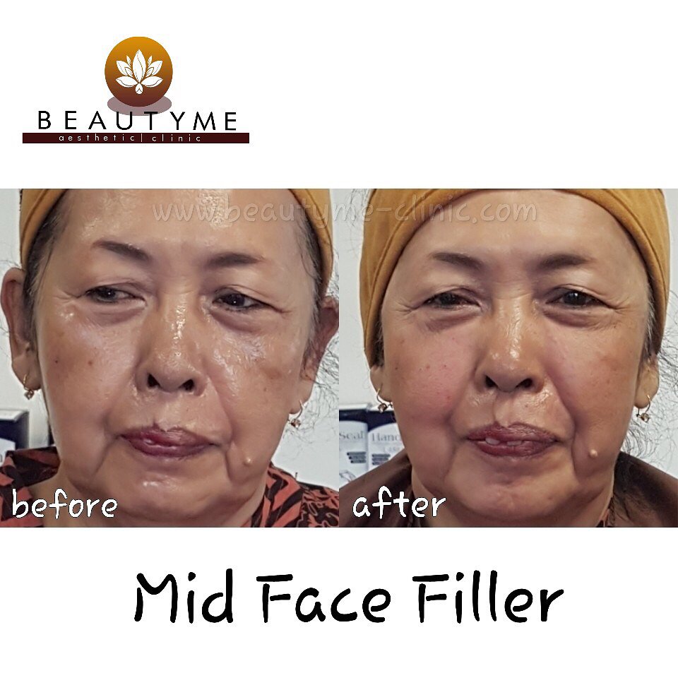 BeautymeC's tweet photo. Filler dpt memperbaiki volume wajah yg sdh berkurang krn penuaan #Pangalengan #Cilengkrang #Cileunyi #Rancaekek #Cicalengka #setraduta #like https://t.co/id9zbxlxch