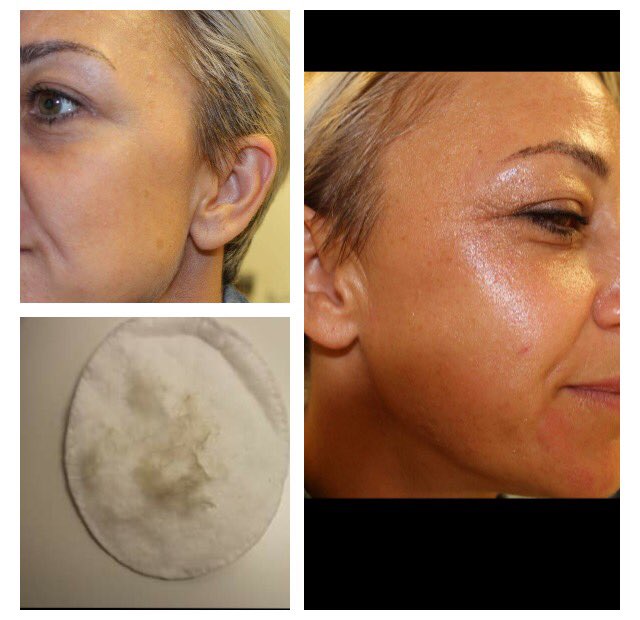 Dermaplaning - smooth fresh skin ✅ make-up goes on beautifully &amp; looks so much better ✅glowing complexion ✅ 
AVAILABLE NOW ☎️07553348334