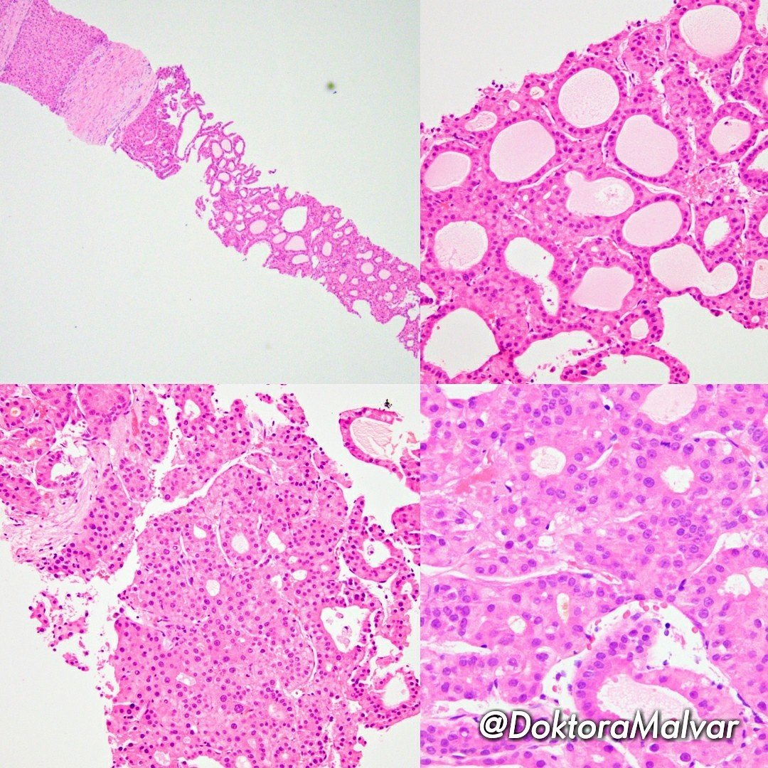 Hepatocellular carcinoma, acinar (pseudoglandular) pattern with background cirrhotic liver. #pathology