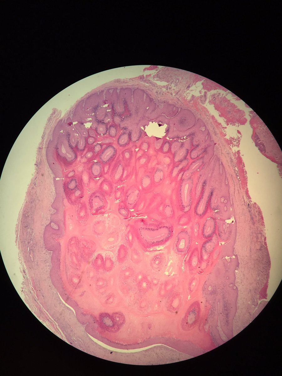 redsnapperpath's tweet photo. Nice #verrucouscyst with #ghostcells 👻 #dermpath https://t.co/dX0uPT3pGz