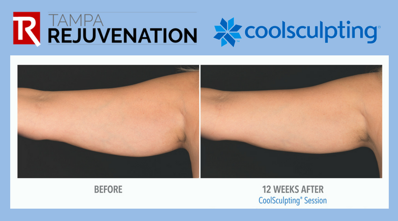 hrttampa's tweet photo. W-A-V-E your arm fat GOODBYE! 
✔️No Needles
✔️No Surgery
✔️No Downtime
813-639-8922 schedule a free consultation to eliminate stubborn fat! https://t.co/kT9WuMB1GE