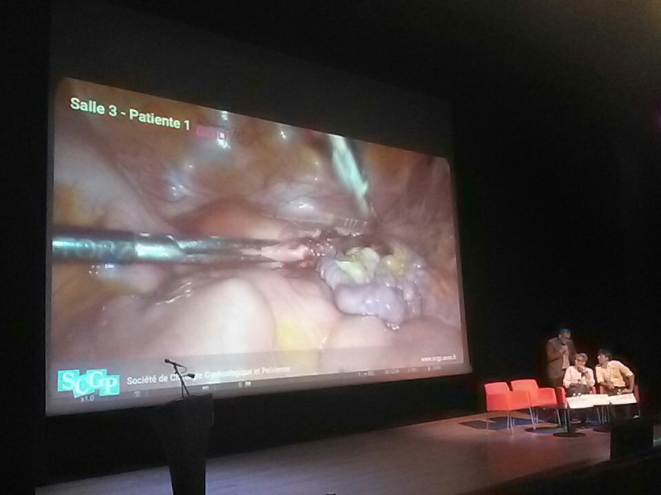 SCGP_officiel's tweet photo. On débute par les transmission depuis la clinique Bouchard ! Ablation d'Essure @GroupeELSAN #SCGP2017 https://t.co/utPhbpff3P