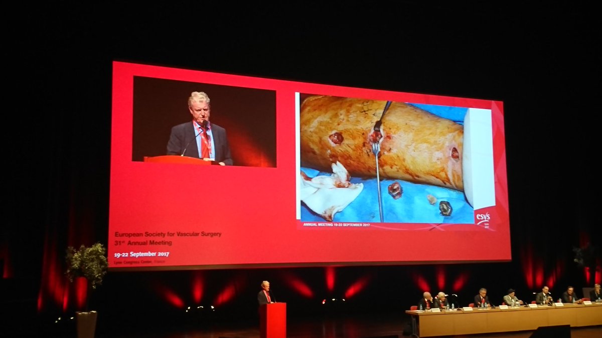 EJVES_ESVS's tweet photo. @mabjo425 The Manchester experience - an example of what to expect... #vascular #trauma #ESVS2017 https://t.co/I6fW0Fy3Qm