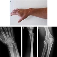 TechHandSurgery's tweet photo. Most Popular: Surgical Treatment of Chronic Essex-Lopresti Lesion: Interosseous Membrane Reconstruction and Radial… https://t.co/fg1tINqkef https://t.co/sdH6q7xCsx