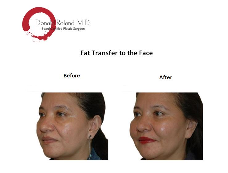 DRolandMD's tweet photo. Fat Transfer to the Face - Affordable and Safe Method for Facial Rejuvenation. #fattoface #fattransfertotheface #facialrejuvenation #surgery https://t.co/RukdWcB0Fb