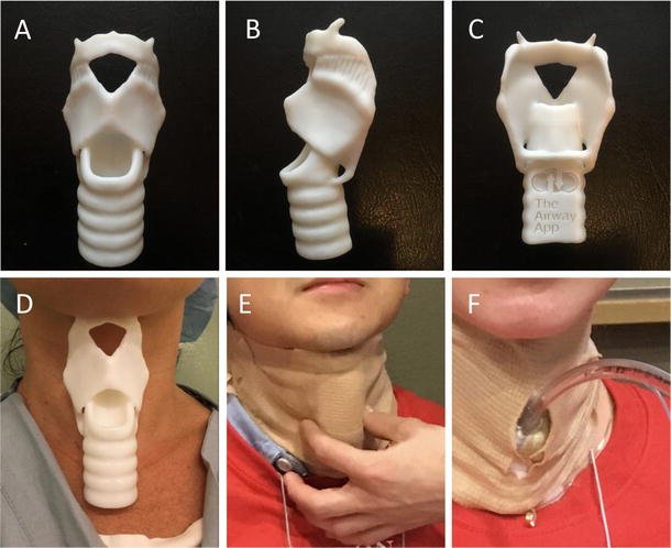Improving cricothyroidotomy skills using a novel open-access three-dimensional model and the <a href="/TheAirwayApp/">TheAirwayApp</a> #FONA  buff.ly/2xcTTjX