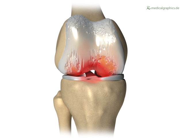 DrHochfelder's tweet photo. Quadriceps exercise relieves pain in knee osteoarthritis.
#kneeosteoarthritis #quadricepsexercise - https://t.co/fIdNiHq6Kp https://t.co/VtzuxVN3h7