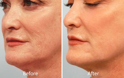 Larry_KoplinMD's tweet photo. It's Never Too Early to Start Protecting Your Skin: Is CO2 Laser Skin Resurfacing Right For You? https://t.co/KJvxGLq8CQ #laserprocedure https://t.co/DeJeOXot8s