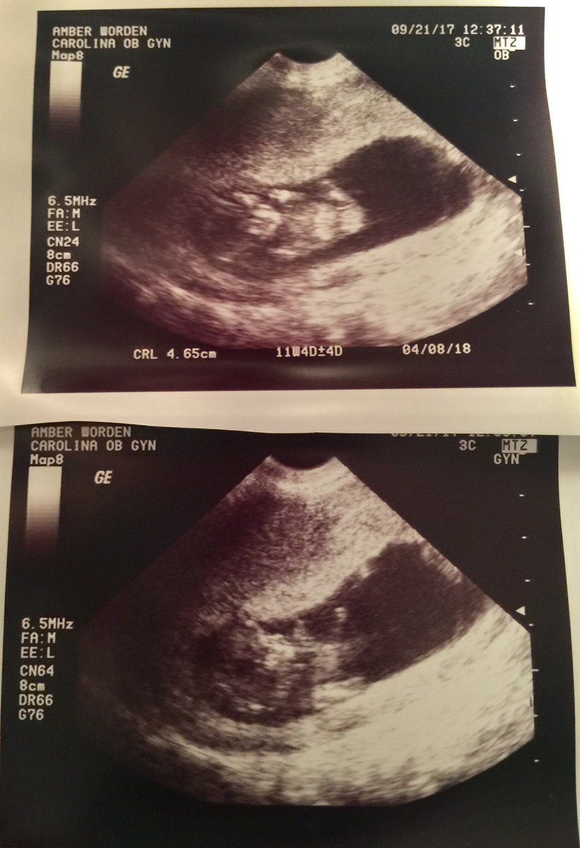 JamisonHarris1's tweet photo. 🍼🍼🍼🍼🍼🍼 https://t.co/L6ZMyExAeC