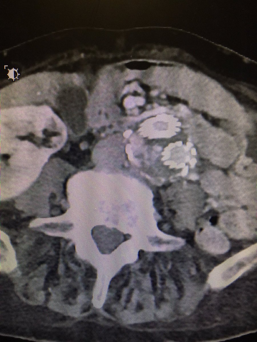 prat_shuk's tweet photo. Transcaval #endoleak onyx embo using #cbct #xperCT w/ @RSP516 @MountSinaiIR @SinaiVascular @SIRspecialists @JVIRmedia @SIRRFS @PhilipsHealth https://t.co/YRaLBNolVo