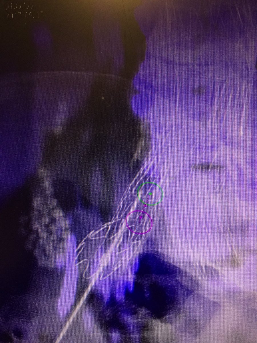 prat_shuk's tweet photo. Transcaval #endoleak onyx embo using #cbct #xperCT w/ @RSP516 @MountSinaiIR @SinaiVascular @SIRspecialists @JVIRmedia @SIRRFS @PhilipsHealth https://t.co/YRaLBNolVo