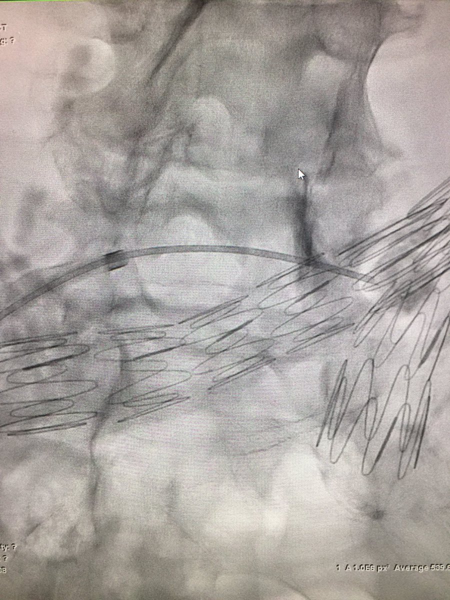 prat_shuk's tweet photo. Transcaval #endoleak onyx embo using #cbct #xperCT w/ @RSP516 @MountSinaiIR @SinaiVascular @SIRspecialists @JVIRmedia @SIRRFS @PhilipsHealth https://t.co/YRaLBNolVo