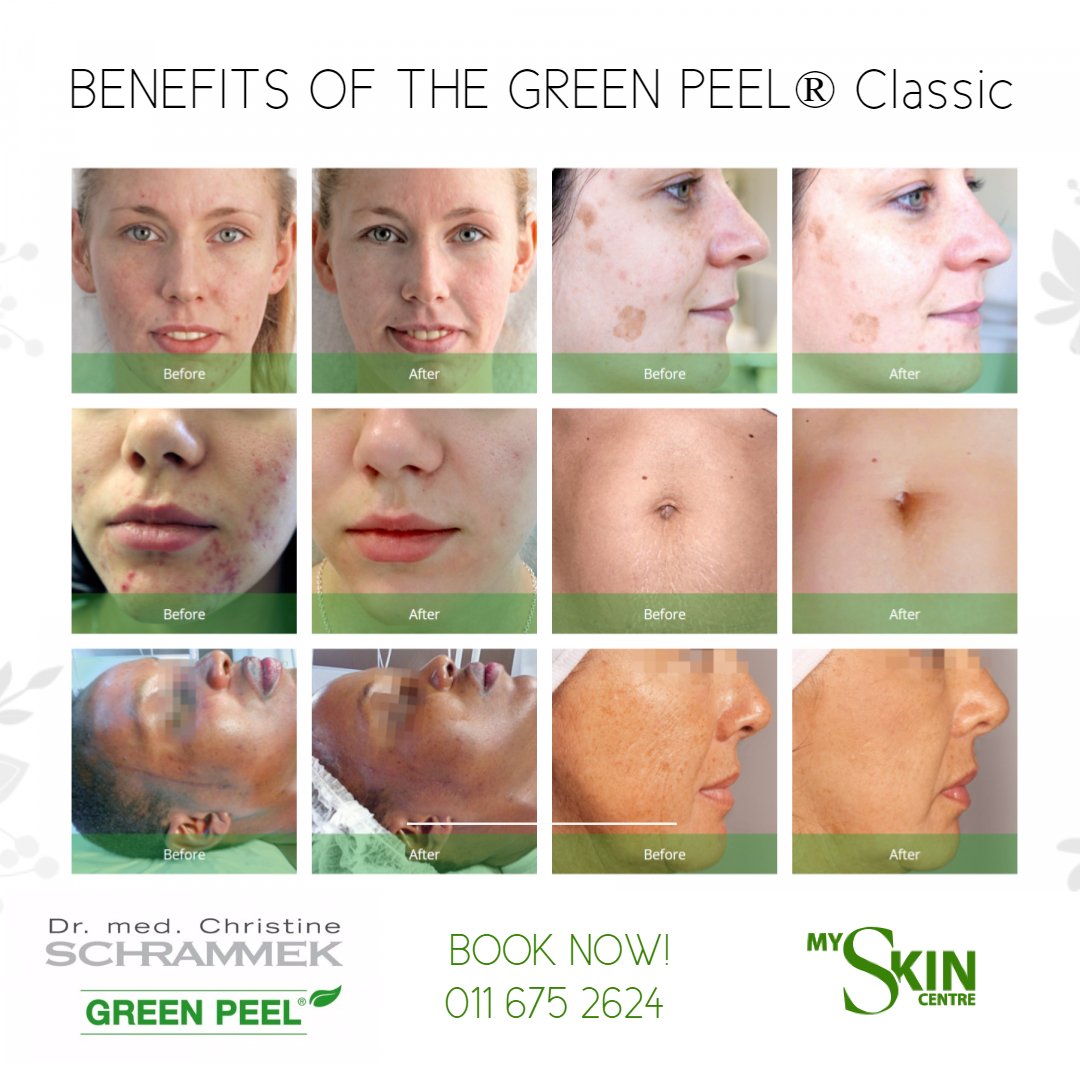on: my skin HERB PEELING 4ml×8pcs My Skin Centre on X: 