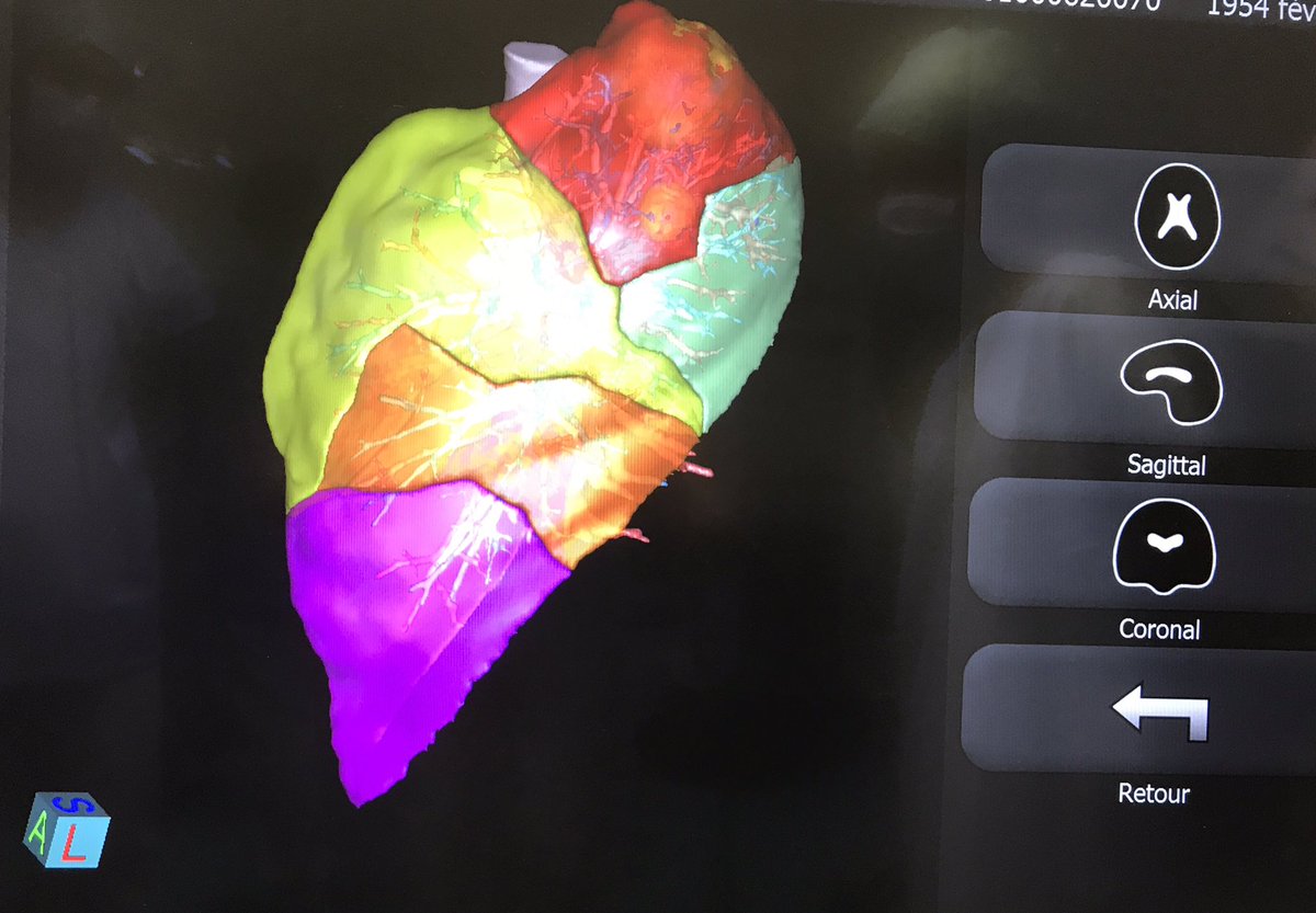 Robotic Trisegmentectomies using a per-operative planning with 3D reconstruction #therapixel #visible patient