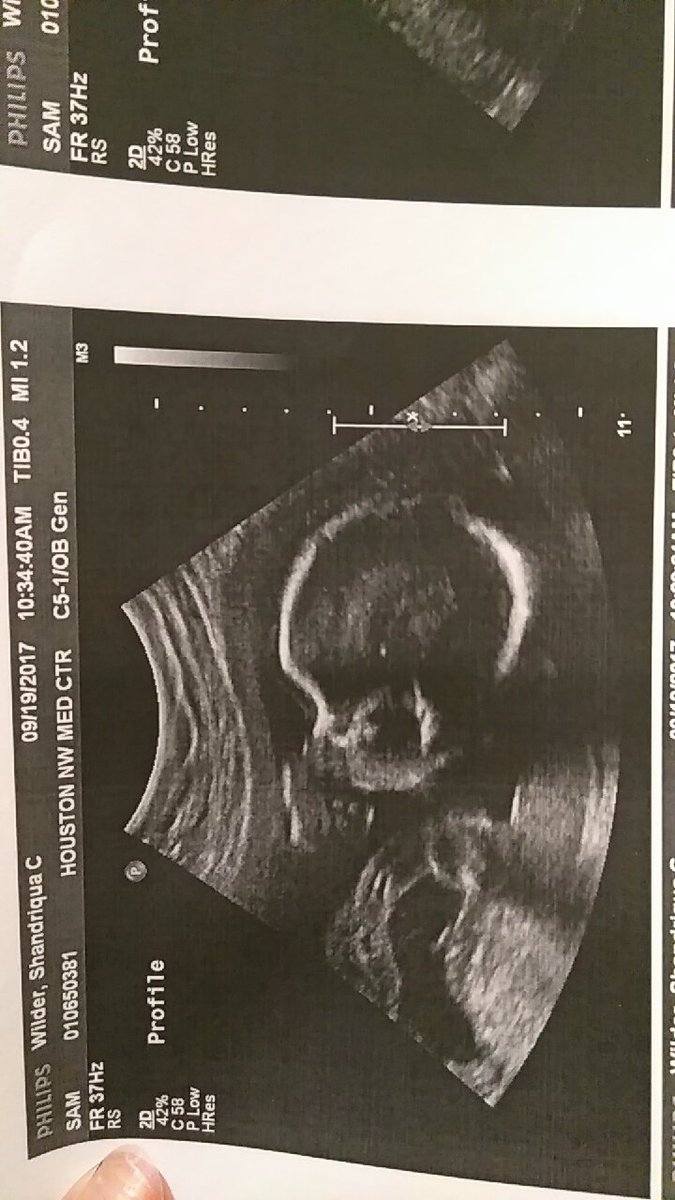 DriquaMz's tweet photo. Baby Boy Got A Big Ass Head! 😘😍😍 #ZakaidenAmehier https://t.co/q75HT90sx2