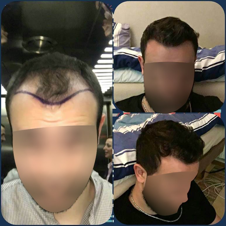 capilCLINIC's tweet photo. 10 meses después del injerto capilar en Turquía con #capilClinic #DrEtoz #Acibadem #trasplanteCapilarTurquía #injertoCapilarTurquía https://t.co/OkZ6OHfQOy