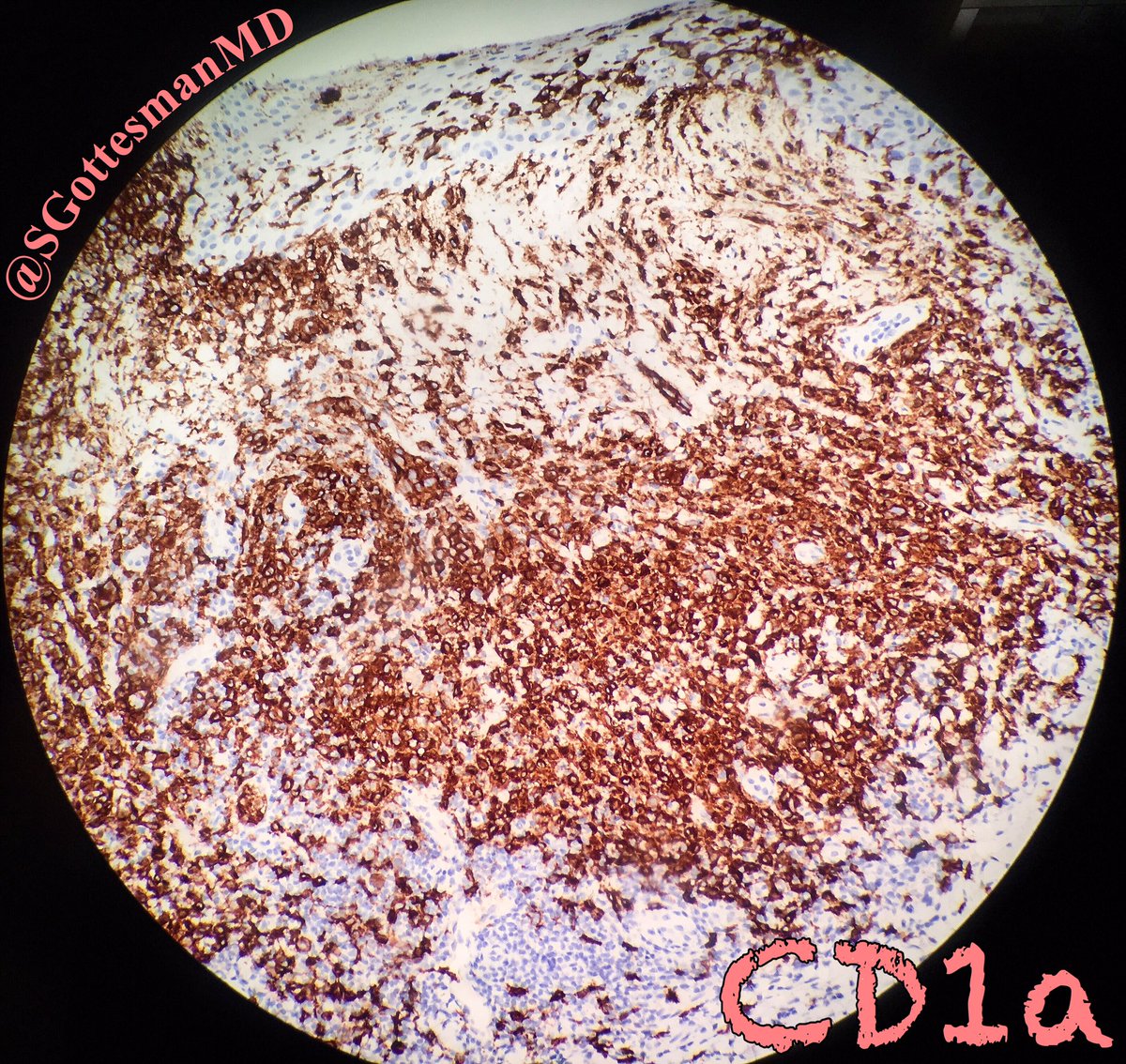 SGottesmanMD's tweet photo. 2yo child. Scalp eruption. Langerhans cell histiocytosis: the kidney bean and coffee groove nuclei. And lymphs & eos too. #CD1a #dermpath https://t.co/oTEDmXAj2w