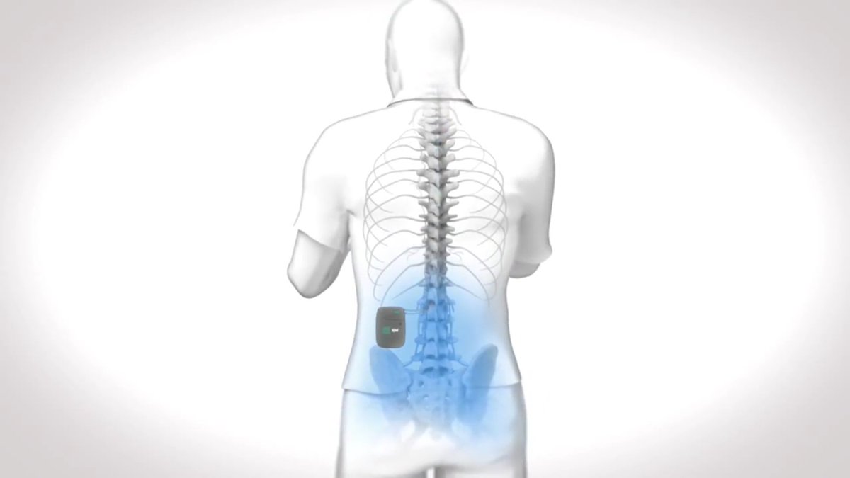 DrCruzeiro's tweet photo. A #estimulação medular é uma técnica que envolve o #implante de um #eletrodo sobre a #medula espinhal, bloqueando a transmissão da #dor. https://t.co/UXdxELzzuW