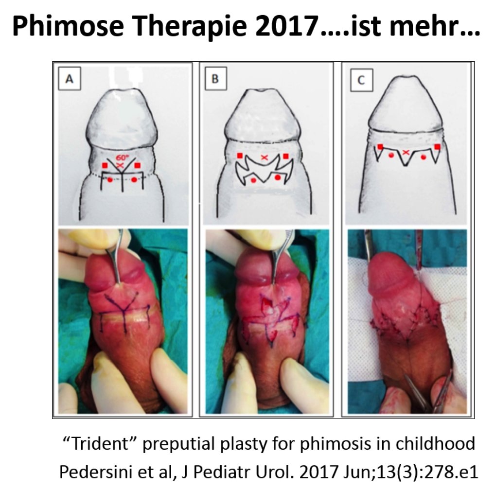 Phimosis – Surgeon for Kids