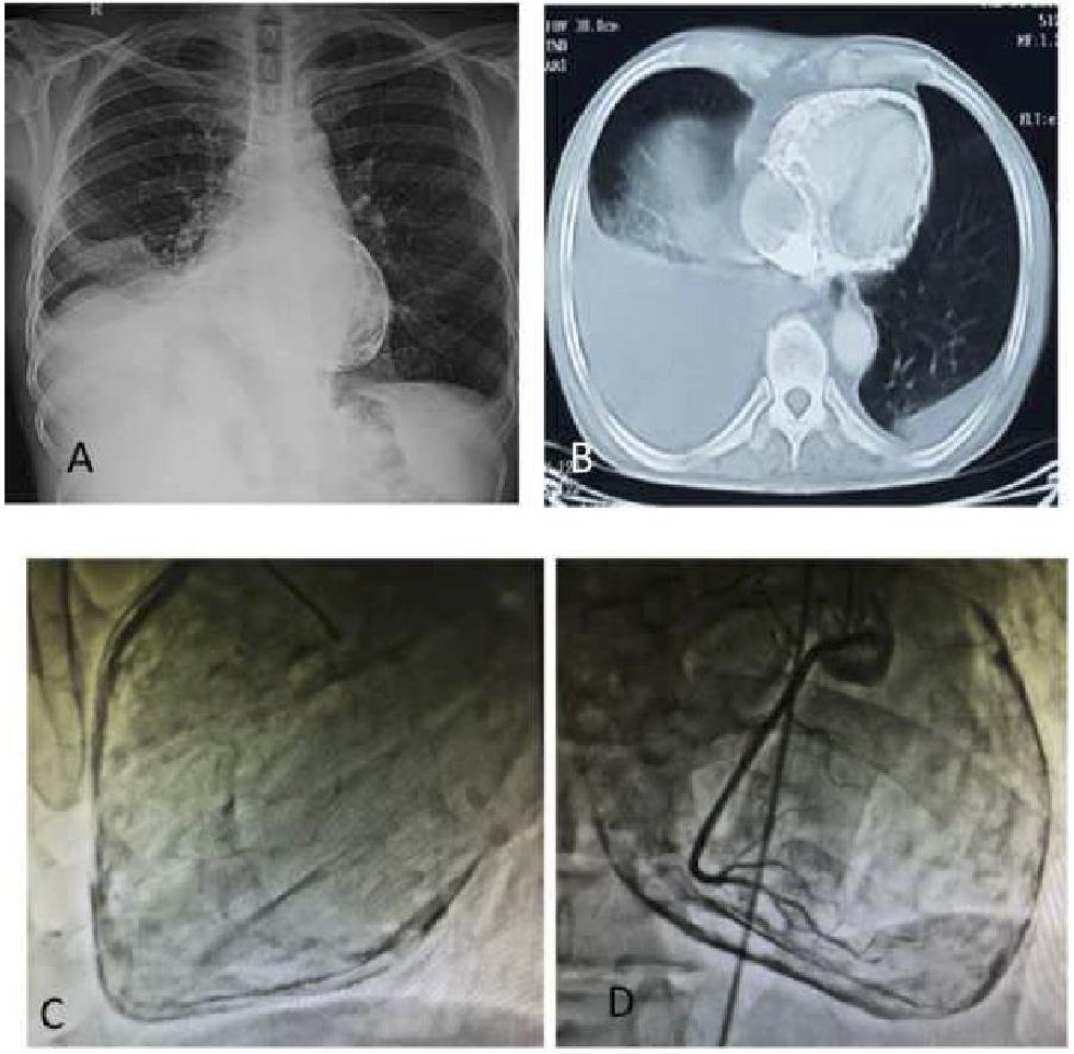 Sudan Heart Journal (@sudanheartj) on Twitter photo Vol5 No1 Image: #ConstrictivePericarditis, an impressive calcification, KhadijaTaifour,<a href="/anas_albadawi/">Anas Albadawi Babiker</a> ,#SudanHeart, sudanheartjournal.com/pdf/v5n1_2017/… Vol5 No1 Image: #ConstrictivePericarditis, an impressive calcification, KhadijaTaifour,<a href="/anas_albadawi/">Anas Albadawi Babiker</a> ,#SudanHeart, sudanheartjournal.com/pdf/v5n1_2017/…
