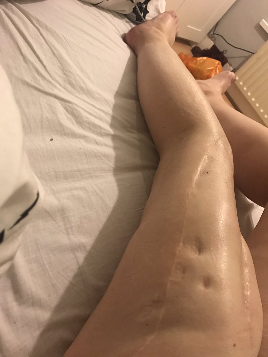 bIuntsweisz's tweet photo. #EveryScarHasAStory
I wasn't going to do this because honestly my body confidence is rock bottom but this tag was way too important to not❤️ https://t.co/MlEChbXIgS