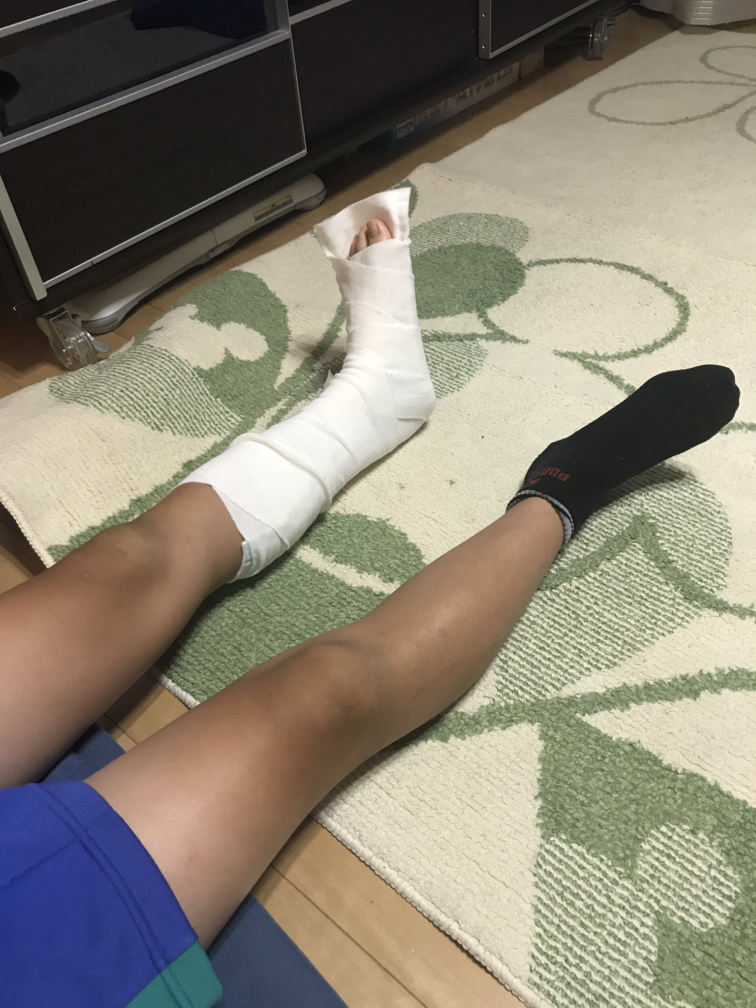 ちい あーとうとう息子の足が 骨折 まあ ヒビだけど 正確に言うと骨挫傷だけど T Co Pdv0xupg0m Twitter
