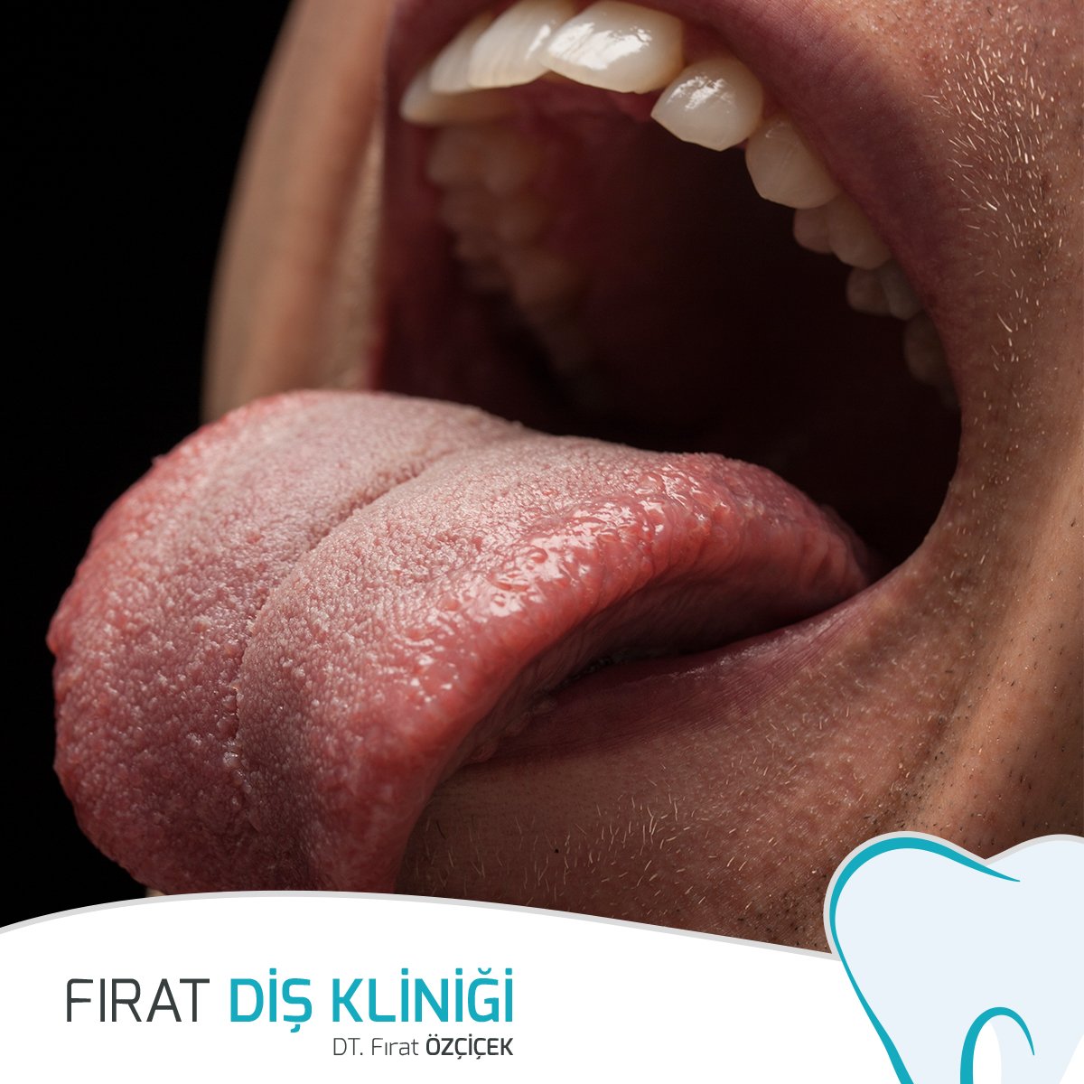 •Ağız kokusuna sebep olan yemek artıkları ve üreyen bakteriler dişlerimiz ve diş etlerimizden çok dilimizin üstünde birikmektedir.