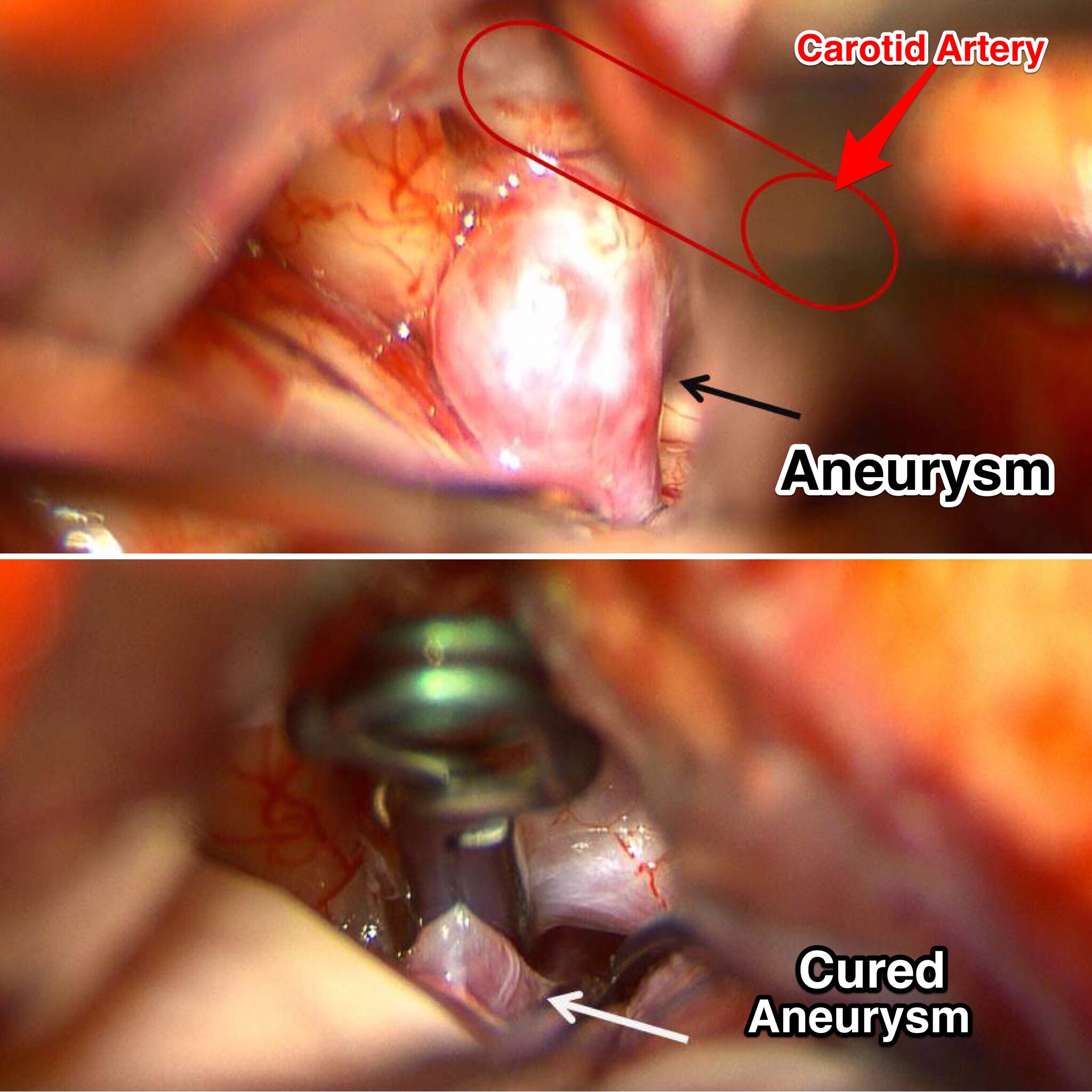 What is aneurysm and is it curable? What is aneurysm and is it curable?