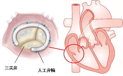 きのした先生 とんぺてぃーず 昨日病院行ってレントゲン撮ってもらったら手術で入れた人工弁輪がくっきり写ってた 人工弁ではない やっぱりジョジョ芸人名乗るくらいなら心臓にリングの１つや２つは入れておかなきゃね