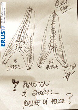 fabrizio dal moro (@fabriziodalmoro) on Twitter photo Question: what about the global volume of Pouch using staplers instead of sutures? <a href="/uroweb/">European Association of Urology (EAU)</a> #erus17 <a href="/benchallacombe/">Ben Challacombe</a> Question: what about the global volume of Pouch using staplers instead of sutures? <a href="/uroweb/">European Association of Urology (EAU)</a> #erus17 <a href="/benchallacombe/">Ben Challacombe</a>
