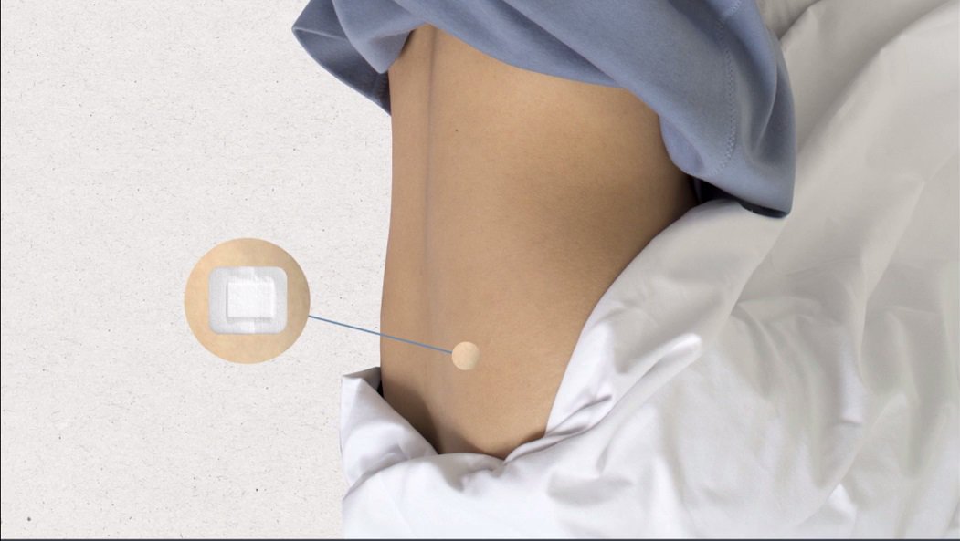 uclh's tweet photo. A #bonemarrowtest involves taking a small sample of bone marrow from inside of your bones for testing. Find out more https://t.co/EXJgahUSLm https://t.co/MdROrdpQSS