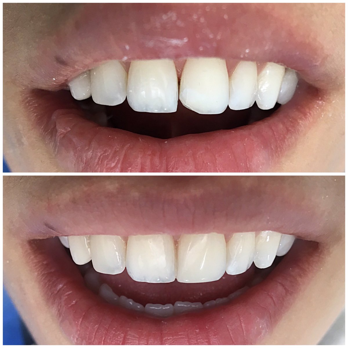 monicabarrerog's tweet photo. Pequeño accidente 😱😱😱 RESUELTO 😃😃 #smartdent #esteticadental #resinas https://t.co/jbtDlH4Ic7