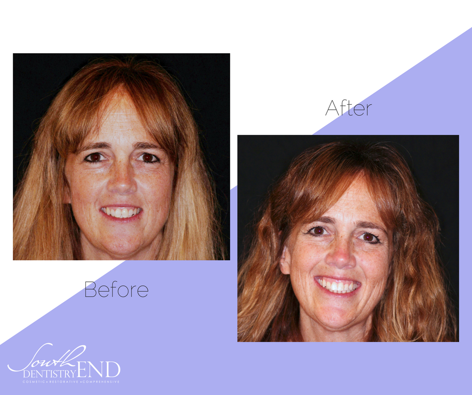 Looking for an alternative to metal braces? #Invisalign aligners are the virtually invisible way to improve your #smile!😁