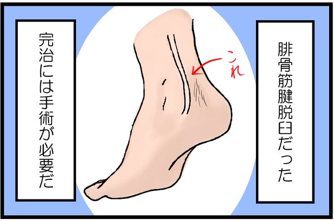 腓骨筋腱脱臼のtwitterイラスト検索結果