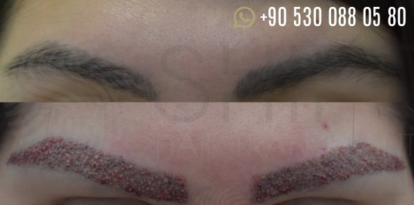shifthairtr's tweet image. You can expect to have thick, natural eyebrows in a couple of months.

Read about #Eyebrow_Transplant at goo.gl/wVC35m

#Turkey