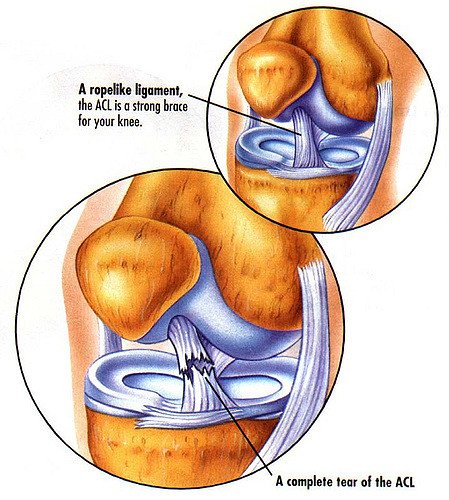KevinKaplanMD's tweet photo. Better fix for torn ACLs. - https://t.co/4O2VDu25IG
#tornACLs https://t.co/9DJGAgtVLD
