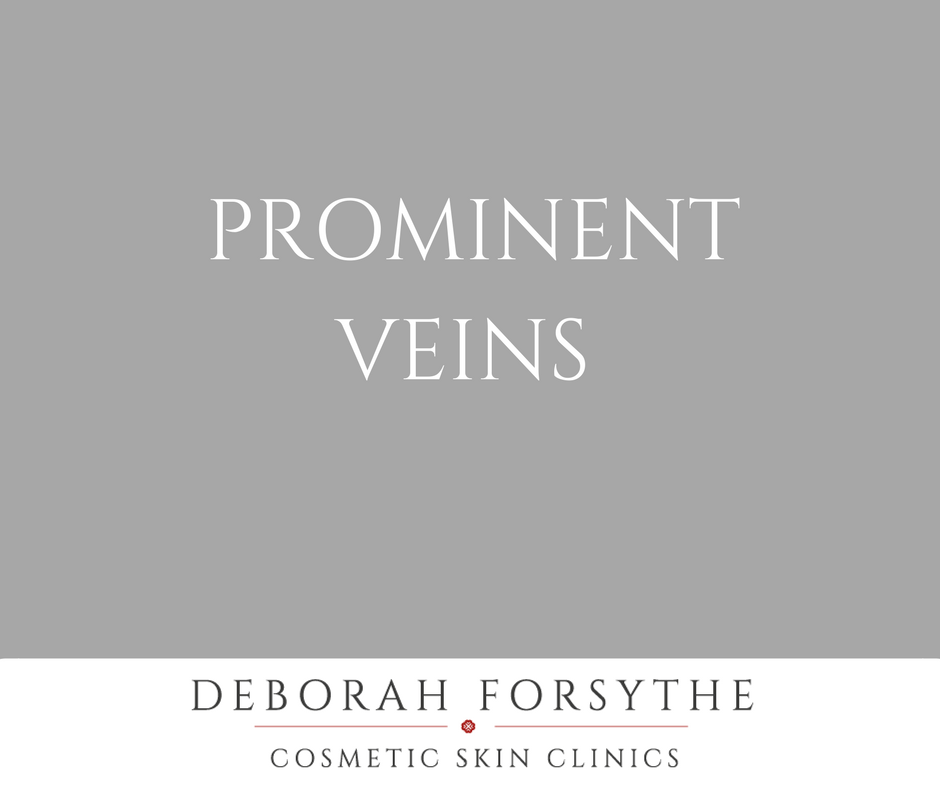DebForsythe's tweet photo. Deborah has a top tip for prominent veins… https://t.co/V1PxQiSxuw