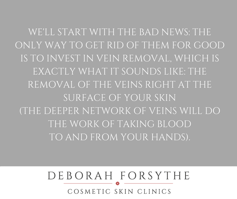 DebForsythe's tweet photo. Deborah has a top tip for prominent veins… https://t.co/V1PxQiSxuw