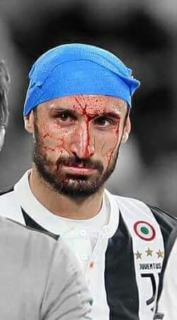Risultati immagini per chiellini punti di sutura