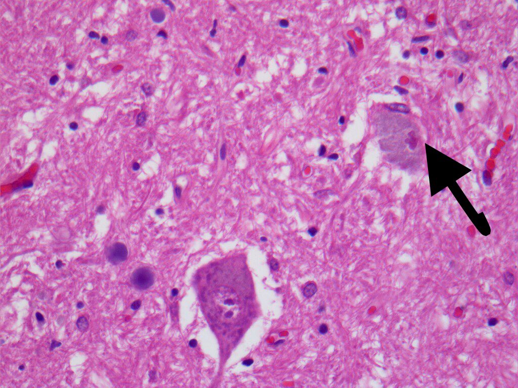 @bansar_bansaria <a href="/DrAldehyde/">Woo Cheal Cho, MD</a> <a href="/BinXu16/">Bin Xu</a> <a href="/smlungpathguy/">Sanjay Mukhopadhyay</a> <a href="/JMGardnerMD/">Jerad Gardner, MD</a> <a href="/kriyer68/">Kalyani Bambal</a> <a href="/Sara_Jiang/">Xiaoyin "Sara" Jiang, MD (She/Her)</a> @DrFNA <a href="/VijayPatho/">Vijay Shankar S</a> Bunina bodies in motor neurons of the anterior horn in ALS